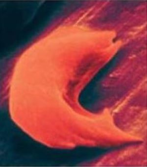 sickle cell - 3